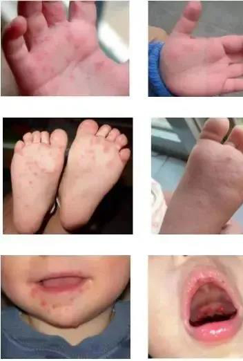 手足口病疱疹(左边是较严重的情况,右边是较轻微的情况)