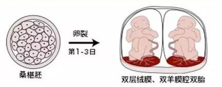 单绒毛膜双羊膜囊单卵双胎单绒毛膜单羊膜囊单卵双胎联体儿除联体儿外