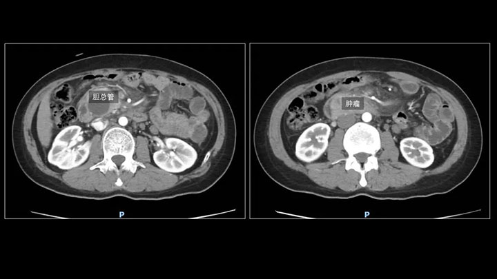 深圳首例完全腹腔鏡下胰十二指腸切除手術